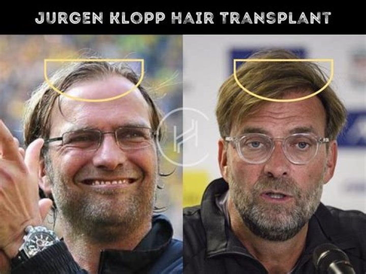Jurgen Klopp Weight Loss: A Closer Look at the Manager's Retirement Transformation