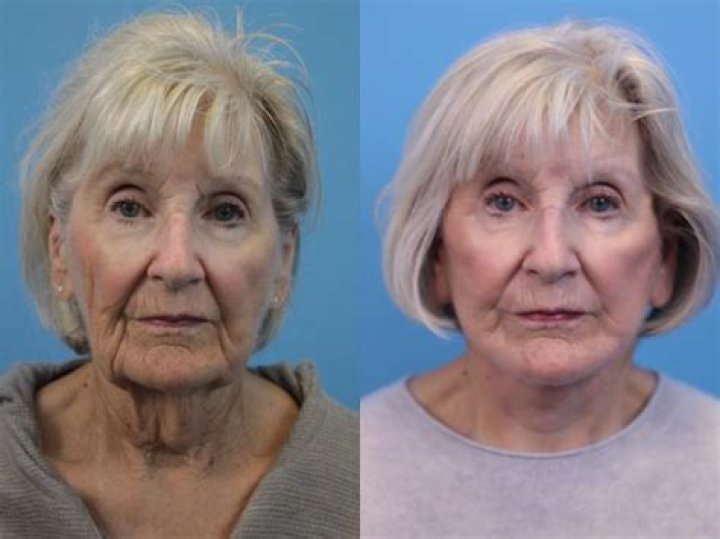 Linda Thompson Facelift Plastic Surgery Before and After